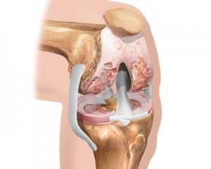 начальная стадия остеоартроза коленного сустава