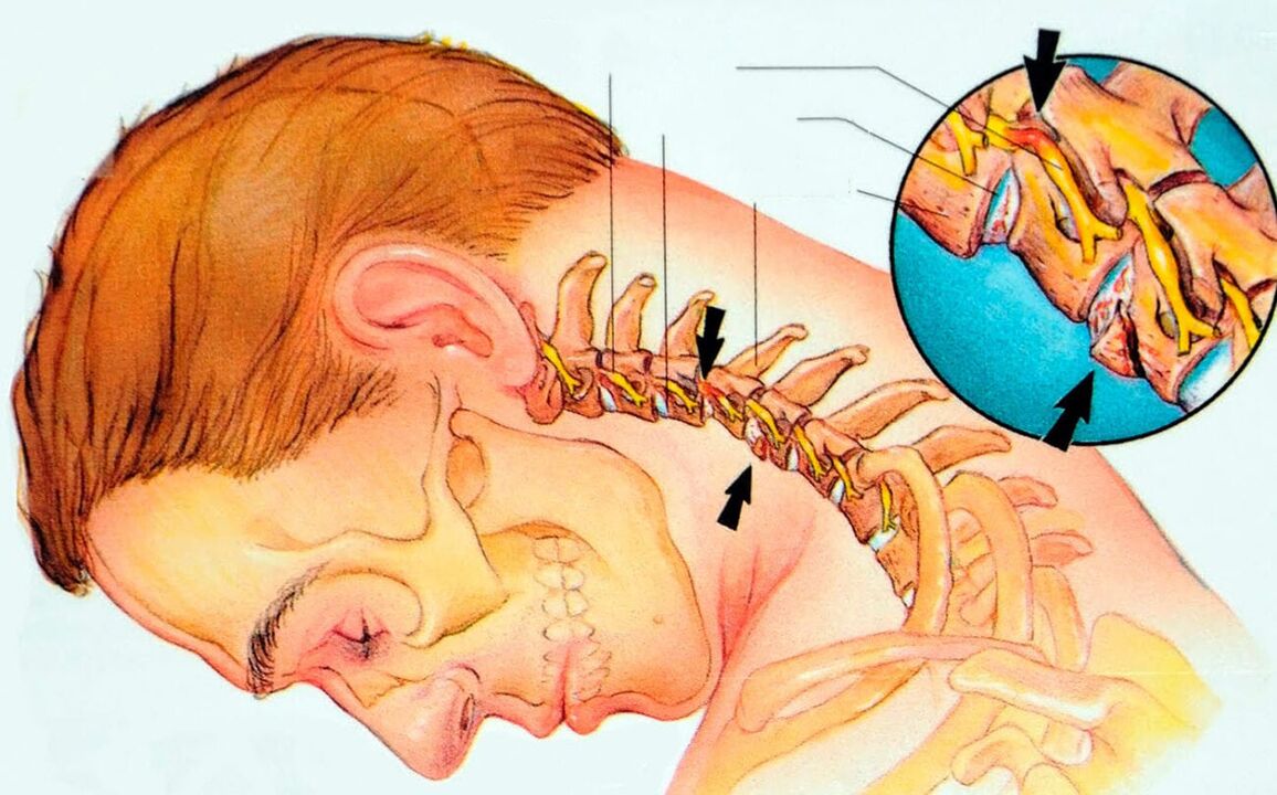 Что такое шейный остеохондоз